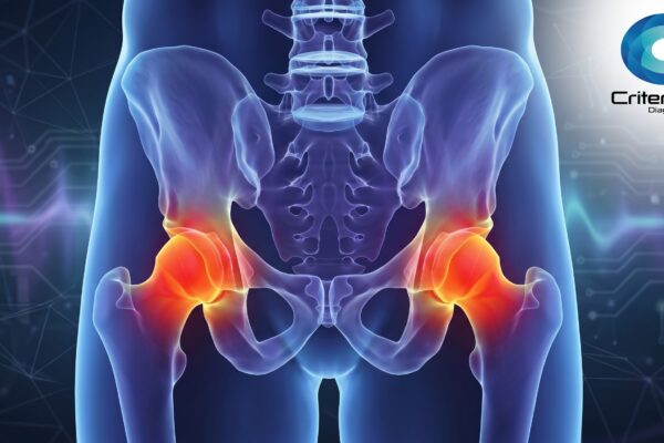 Impacto femoroacetabular em Fortaleza: dor no quadril em jovens e atletas